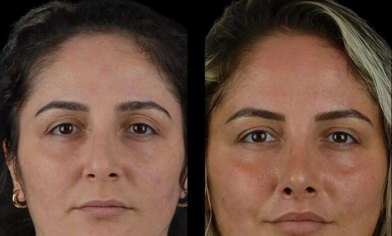 Best Doctors in Dubai Positive Reviews from Cheek Fillers Patients