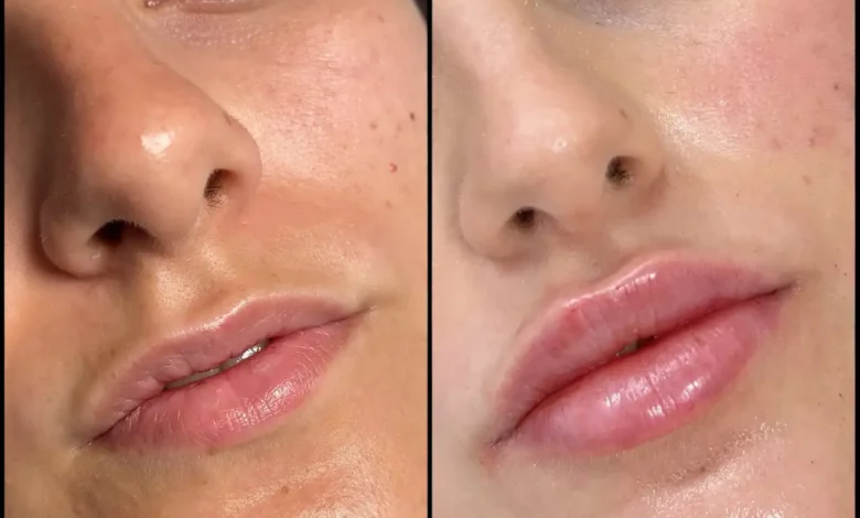 Best Doctors in Dubai for Fillers Your Path to Flawless Skin