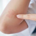 Round Patches on Skin: What They Could Mean