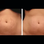 Skin Renewal Breakthrough: Radiofrequency (RF) Microneedling Treatments in Dubai
