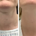 Best Plastic Surgeon in dubai for Minimally Invasive RF Microneedling