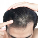 Does GFC Treatment Work for Stress Hair Loss?