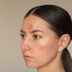How Laser Acne Scar Treatment Softens Old Scarring ?