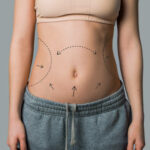 How Liposuction Refines Natural Body Shape ?
