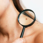 What Makes Modern Mole Removal So Precise?