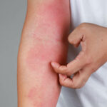Why Try Eczema Treatment for Stubborn Skin Issues?