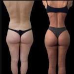 J-Plasma Skin Tightening: How the Best Plastic Surgeons in Dubai Deliver Superior Results