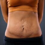 How Tummy Tuck Removes Excess Skin and Fat