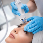 What Makes RF Microneedling a Top Skin Treatment
