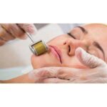 How Microneedling Can Transform Your Skin Texture