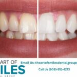 Dental Fillings Fontana | Trusted Restorative Care by Local Dentist