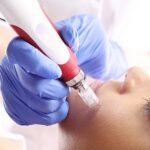 The Ultimate Guide to Birth Mark Removal Treatment in India – Procedure, Safety, and Results | Essence Skin Care