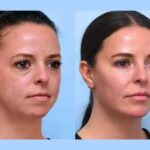 Best Plastic Surgeon in Dubai Thread Lift Expertise Combining Art, Science, and Precision Skills