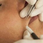 What Makes Electrolysis Laser Hair Removal Long Lasting
