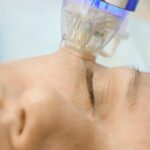 What Recovery Time Is Needed After RF Microneedling