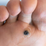 What Recovery Time Is Needed After Warts Removal