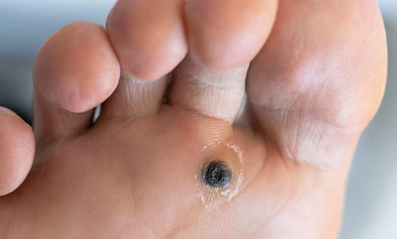 What Recovery Time Is Needed After Warts Removal What Recovery Time Is Needed After Warts Removal