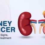 Kidney Cancer Treatments In Bangalore | Worldofurology