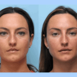 Thread lift Treatment in Dubai with Minimal Downtime