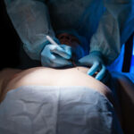 Is Gynecomastia Surgery Painful or Risky Procedure?