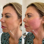Why Celebrities Choose a Best Plastic Surgeon in Dubai for Endolift
