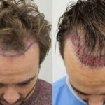 Is Hair Transplant Safe in Pakistan? What You Should Know Before Deciding