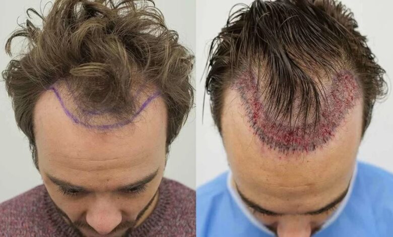 Is Hair Transplant Safe in Pakistan? What You Should Know Before Deciding