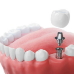 Dental Implants in Simi Valley: What Locals Wish They Knew First