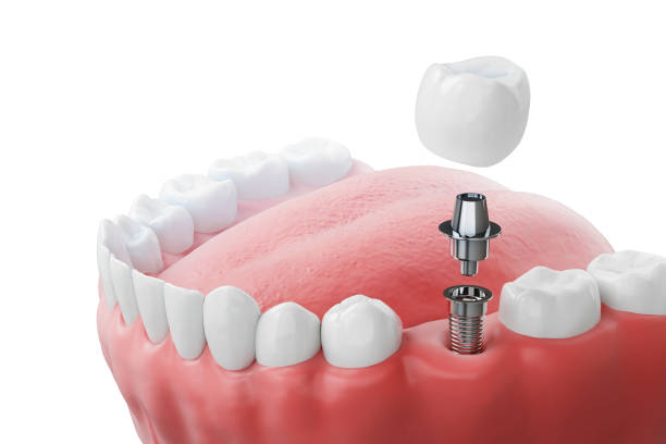 Dental Implants in Simi Valley: What Locals Wish They Knew First