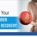 Recovery Time After Gallstone Surgery: Tips for Smooth Gallbladder Removal Recovery at Bhardwaj Hospital Noida