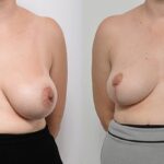 Breast Reduction In Australia & Gynecomastia Surgery In Australia – Handa Plastic Surgery
