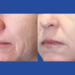 Non-Surgical Skin Tightening with Fractional Radiofrequency (RF) Microneedling Treatments in Dubai