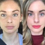 Radiofrequency (RF) Microneedling Treatments in Dubai for Radiant Skin