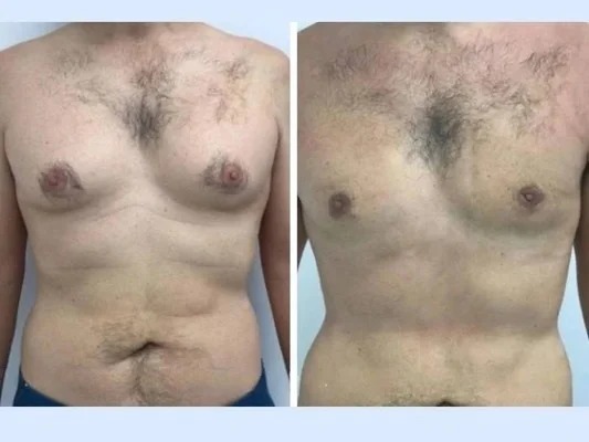 Best Gynecomastia Surgery in dubai for Quick Recovery and Results