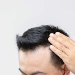 Does Hair Transplant Require Multiple Sessions