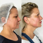 Endolift Success Stories with the Best Doctors in Dubai