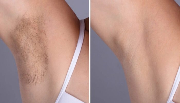 Best Plastic Surgeons in dubai Using Advanced Electrolysis Laser Hair Removal Best Plastic Surgeons in dubai Using Advanced Electrolysis Laser Hair Removal
