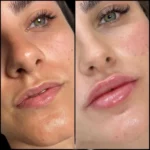Best Aesthetic Clinics in dubai with Fillers Specialists in Jumeirah