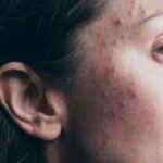How Hormonal Changes Influence Skin Disorders