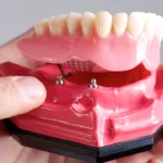 Smile Without Breaking the Bank: Affordable & Mini Dental Implants in Houston