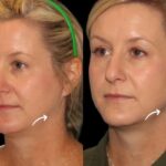 Sculptra Fillers in Dubai for Skin Texture Improvement