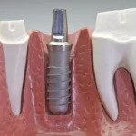 What Are Dental Implants Cantonment FL?