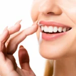 What Is Teeth Whitening Lincoln AL?