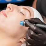 What Makes Microneedling So Popular?