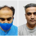 Best Hair Transplant In Delhi | Hair Loss Treatment Cost In Delhi – Derma Clinix