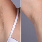 Best Plastic Surgeon in dubai on Benefits for Male Electrolysis Laser Hair Removal in Dubai