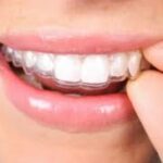 Straighten Your Smile Discreetly: Discover Adult Clear Aligners That Fit Your Life