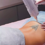 How Does Picosure Laser Tattoo Removal Reveal Flawless Skin Fast
