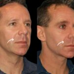 Best Aesthetic Clinics in Dubai Sculptra Fillers Dual Approach