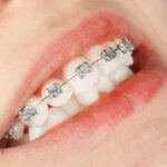 Smile Strong at Any Age: Why Adult Braces in Lake Oswego Are Worth It